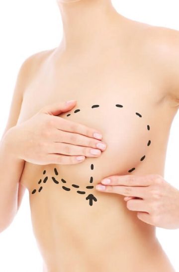 Breast_augmentation_4-min