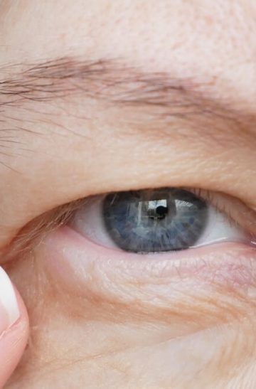Eyelid_Upper