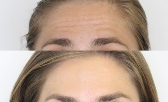 botox_gal_1