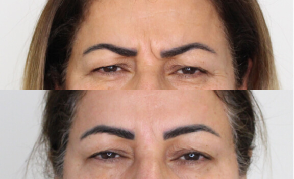 botox_gal_2