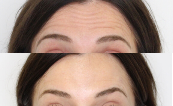 botox_gal_3
