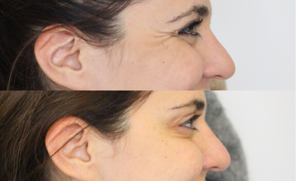 botox_gal_4
