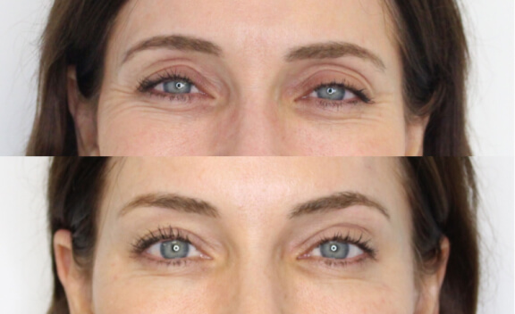 botox_gal_5