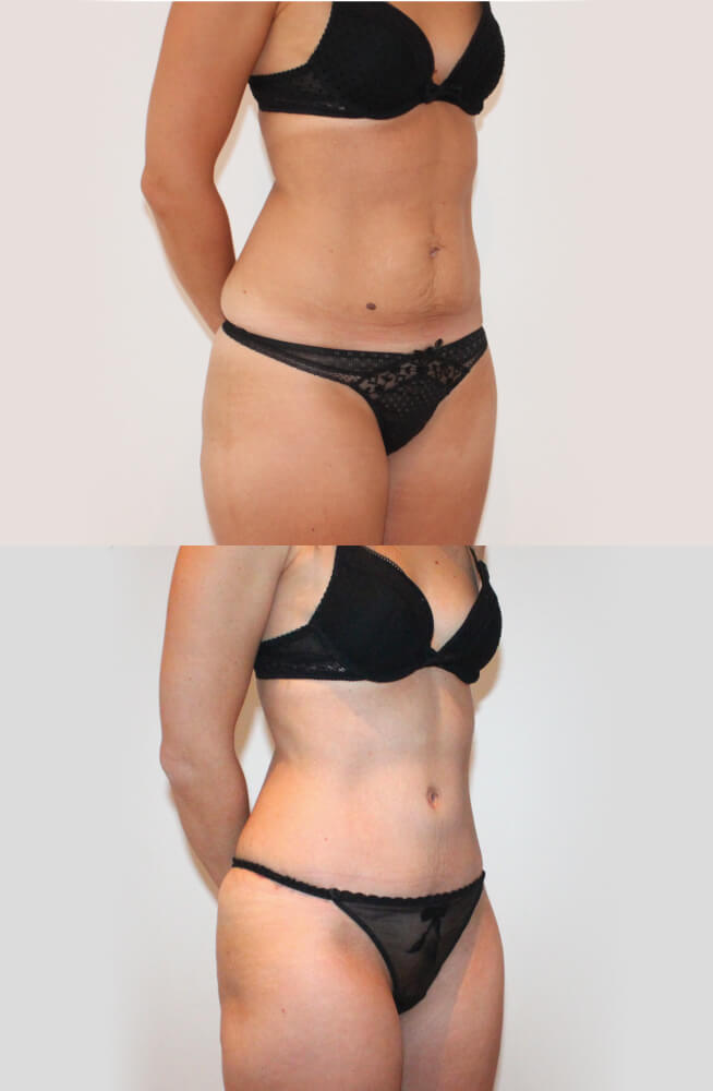 Abdominoplasty 1 - 2