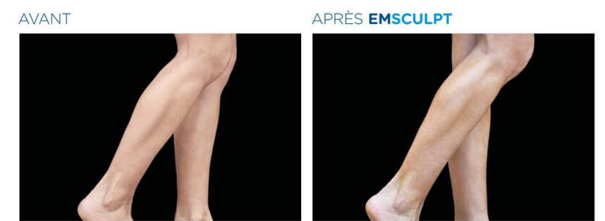 EM_Sculpt_Avant_Apres_Mollets
