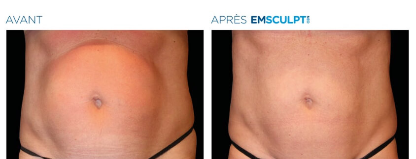 Em_Sculpt_Avant_Apres_Ventre