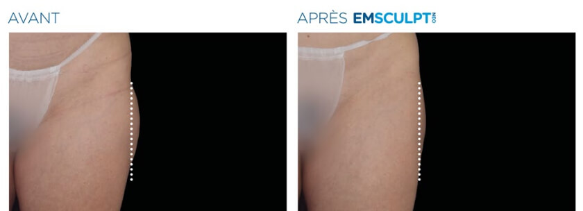 Em_Sculpt_Avant_apres_Cuisse