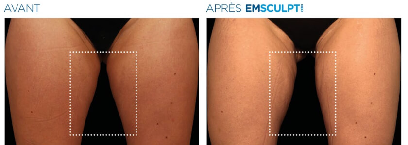 Em_Sculpt_Avant_apres_interieur_Cuisse