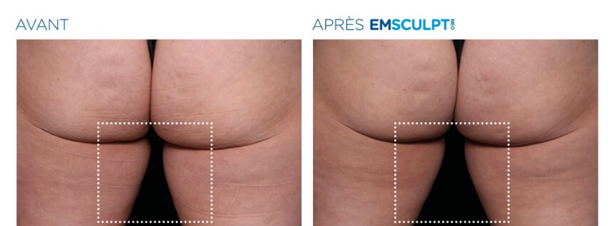 Em_Sculpt_Fesses