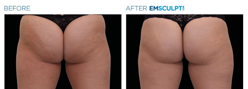 Em_Sculpt_Muscle_fesses_Avant_Apres