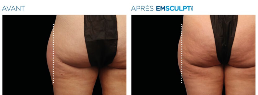 Em_Sculpt_fesses_externes