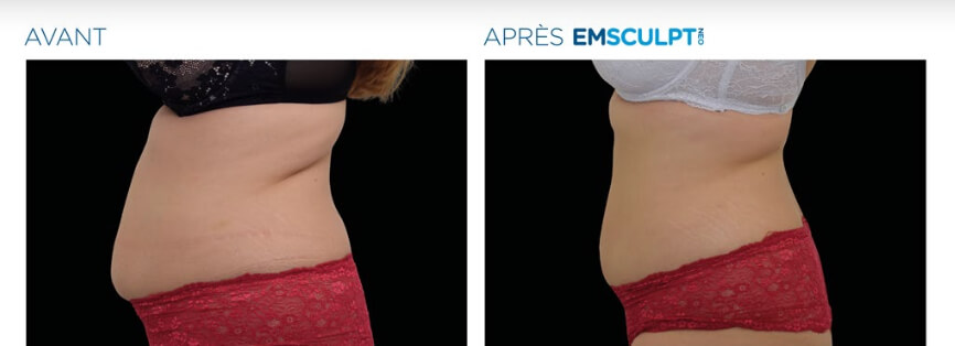 Em_Sculpt_ventre_femme_avant_apres