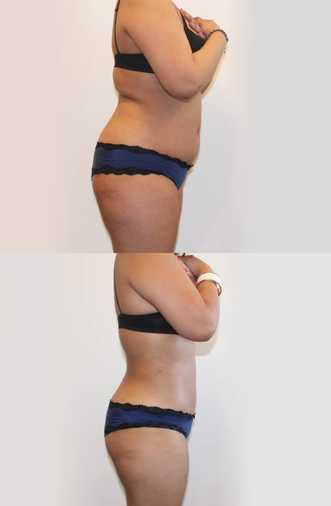 I 1-liposuccion-mob