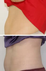 Abdominoplastie Genève