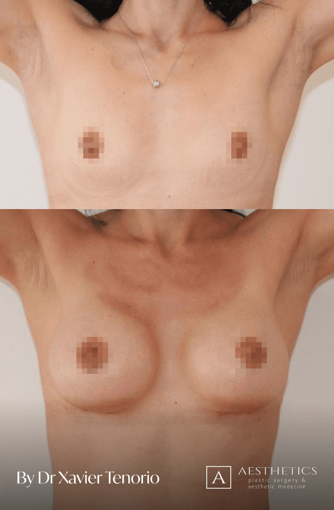 Augmentation mammaire Geneve