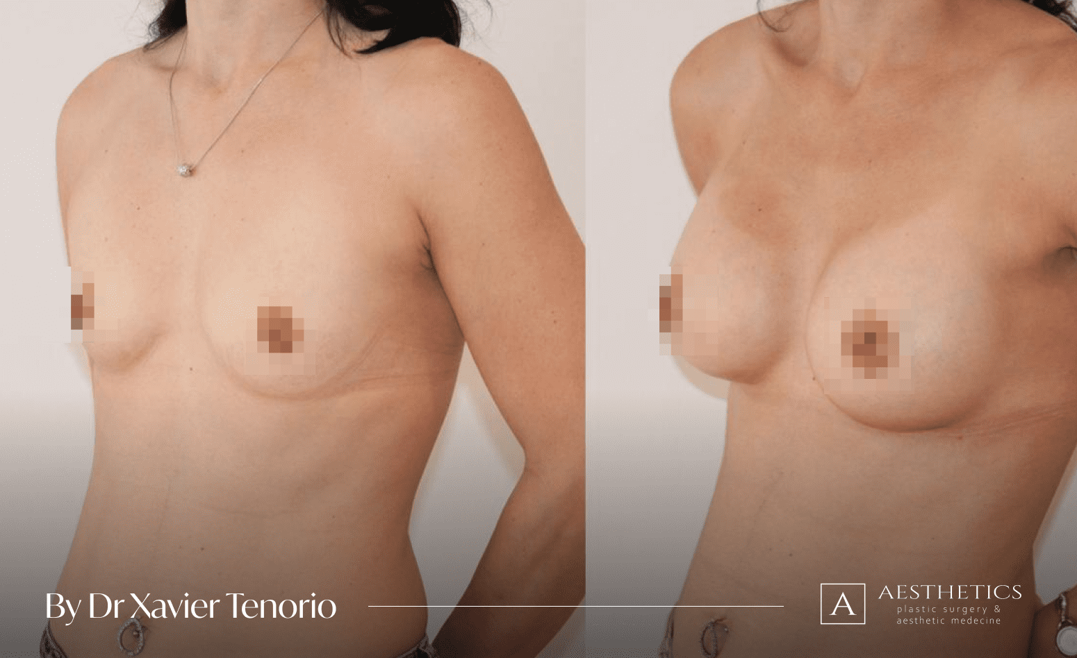 Augmentation mammaire Geneve