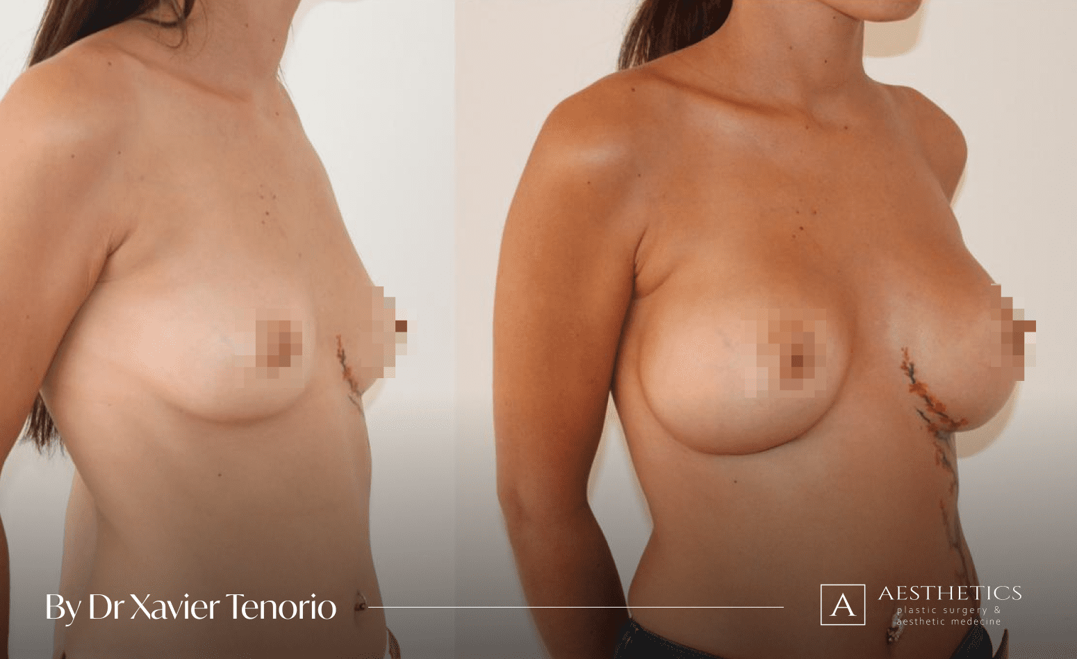 Augmentation mammaire Geneve Suisse