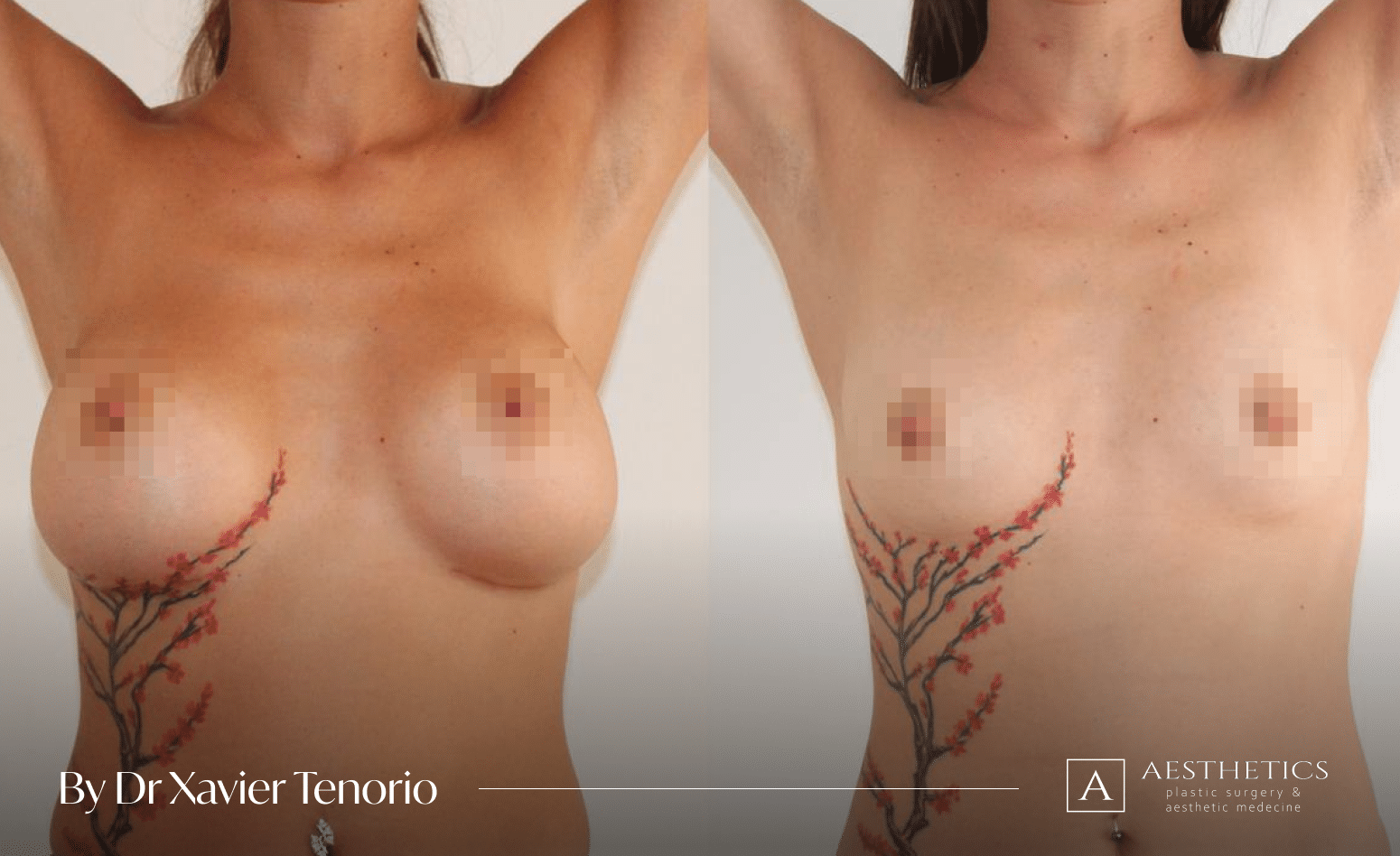 Augmentation mammaire Genève de Face