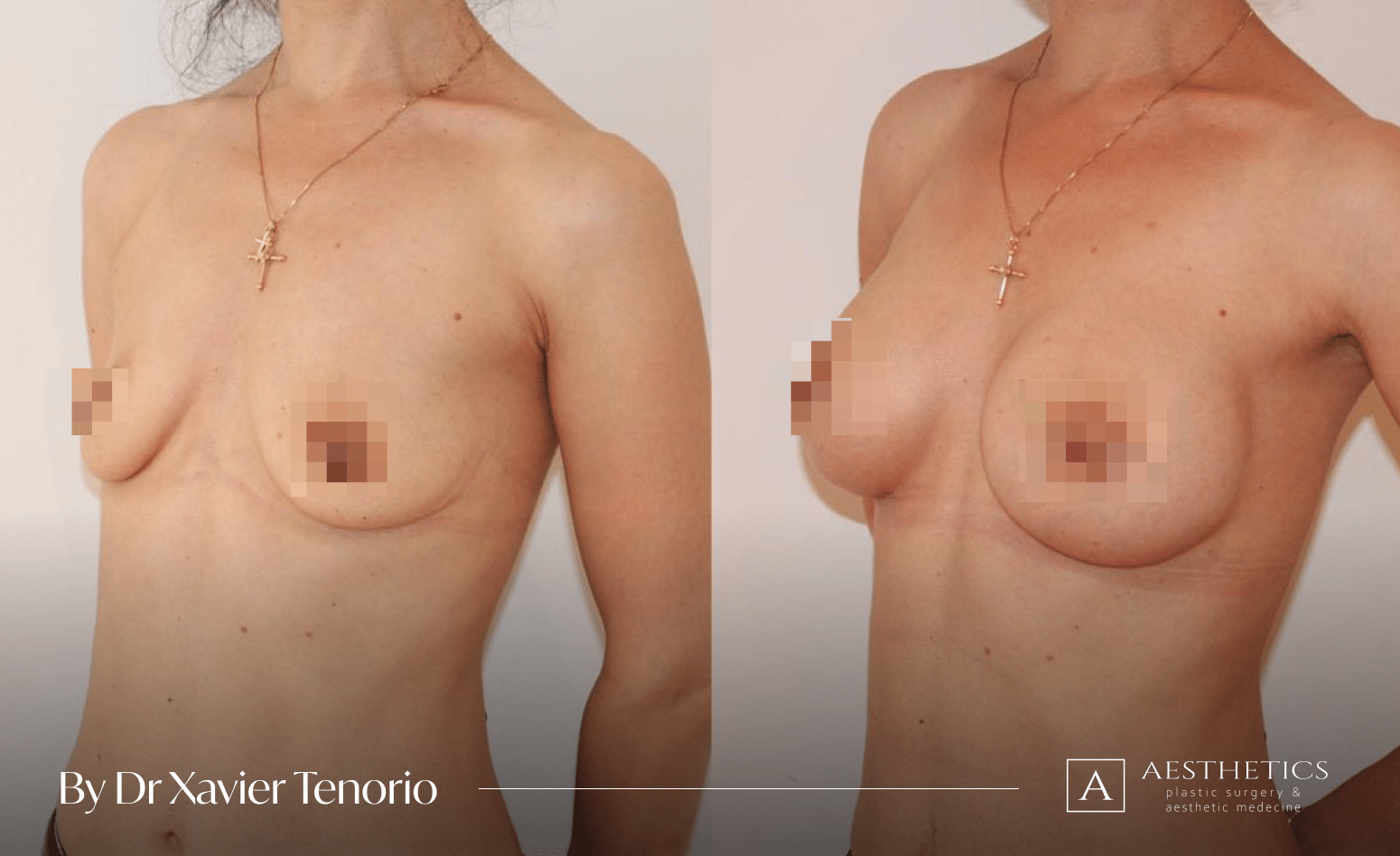 Augmentation mammaire Geneve protheses rondes