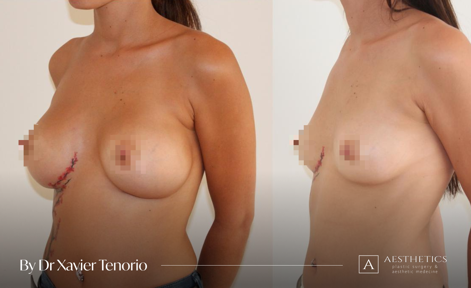 Augmentation mammaire Suisse