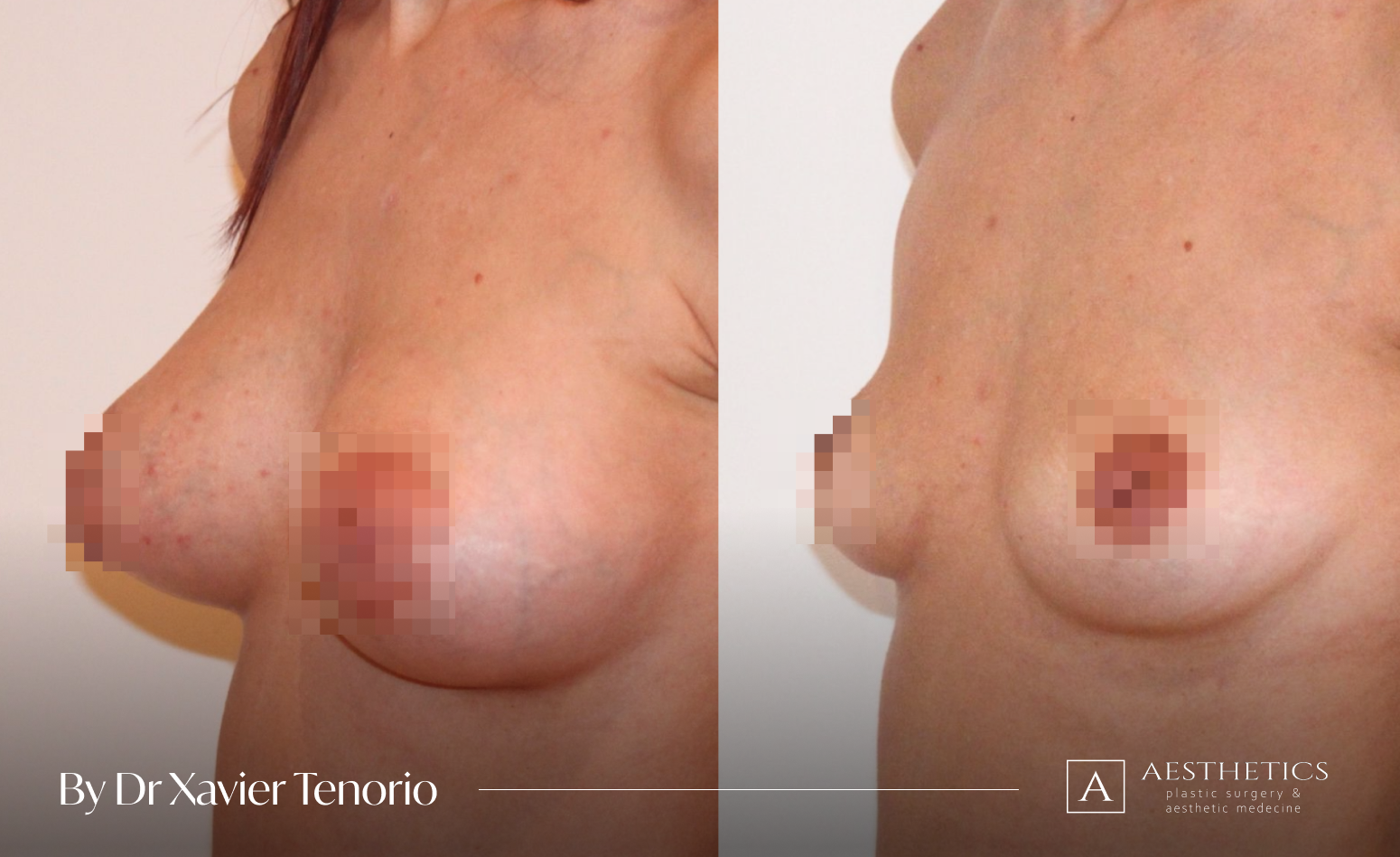 Augmentation mammaire grande taille