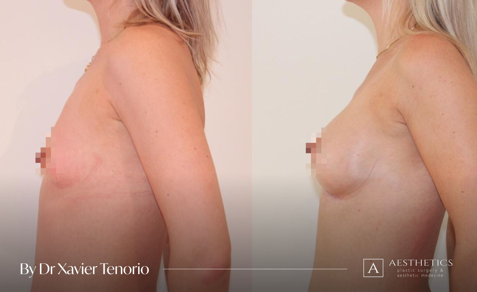 Augmentation mammaire profil Geneve