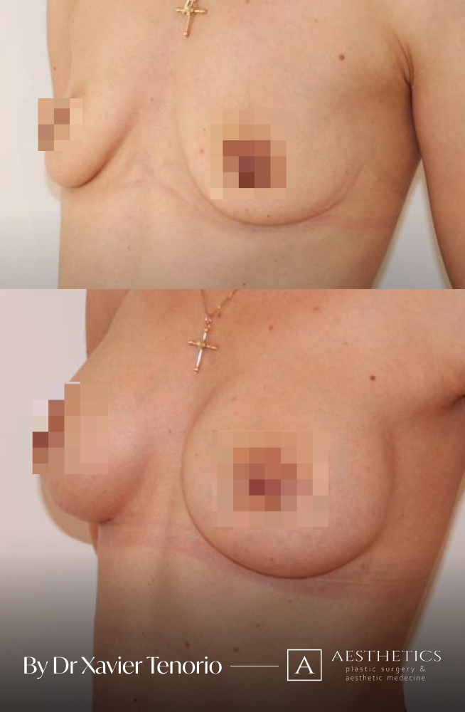 Augmentation mammaire ronde