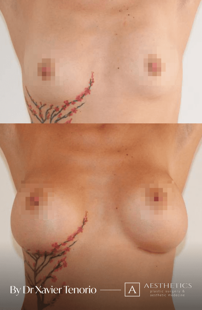 Augmentation mammaire vue de face
