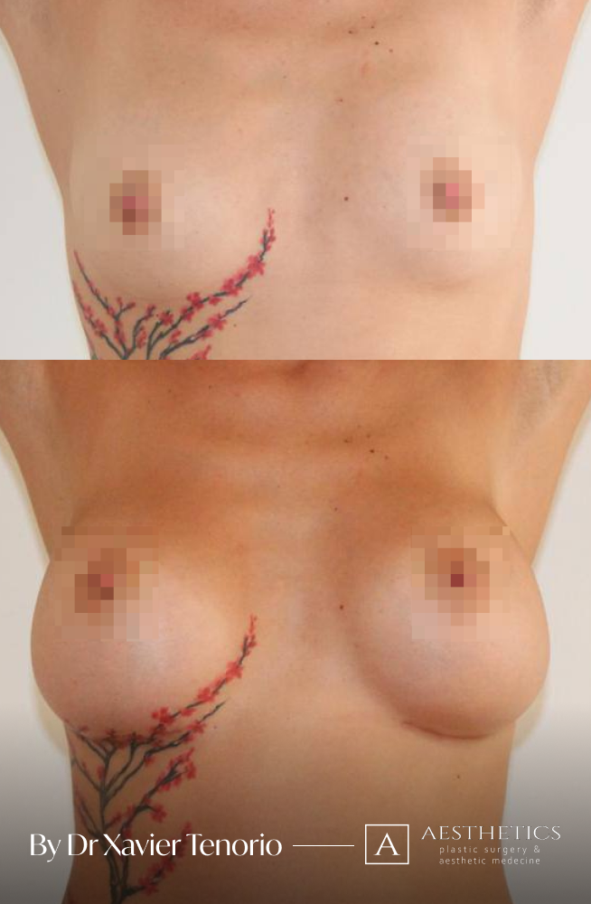 Augmentation mammaire vue de face
