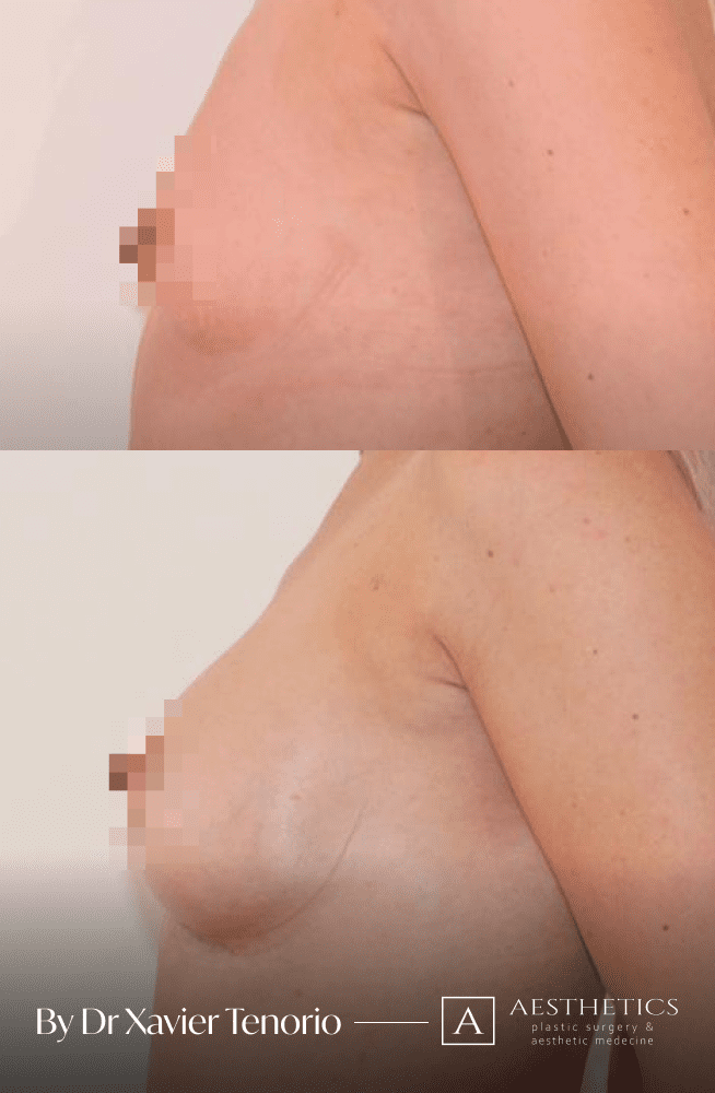 Augmentation mammaire vue de profil