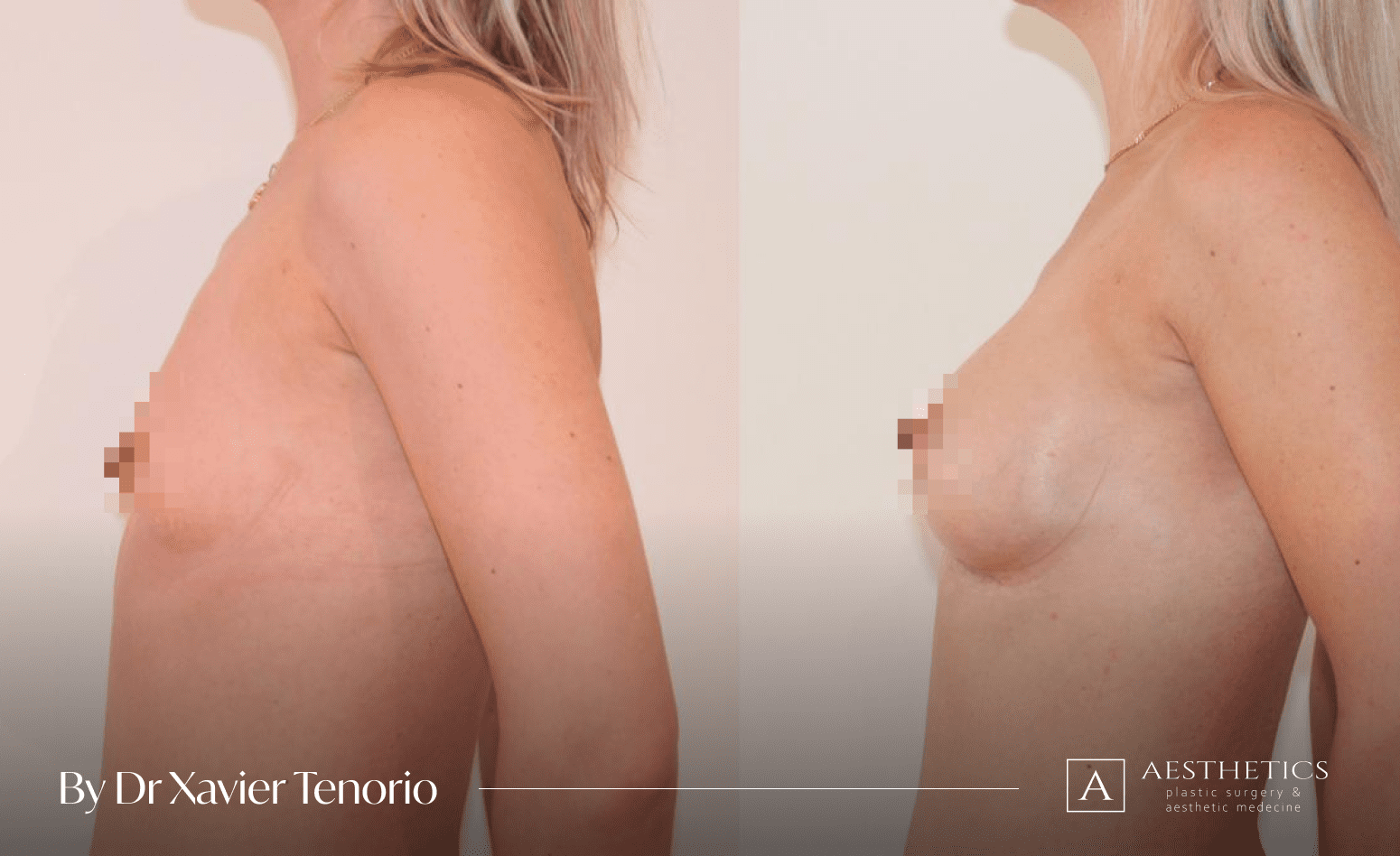 Augmentation mammaire vue de profil