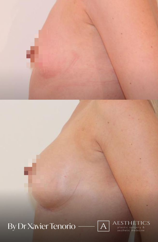 Augmentation mammaire vue de profil