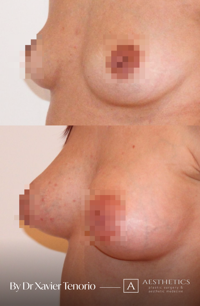 Belle augmentation mammaire