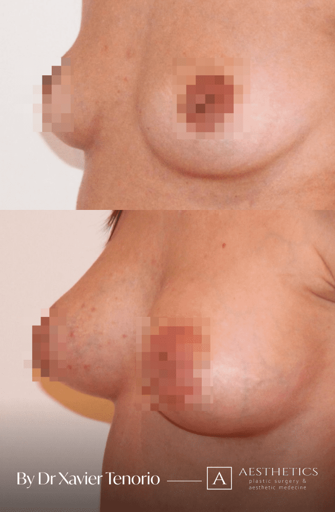 Belle augmentation mammaire