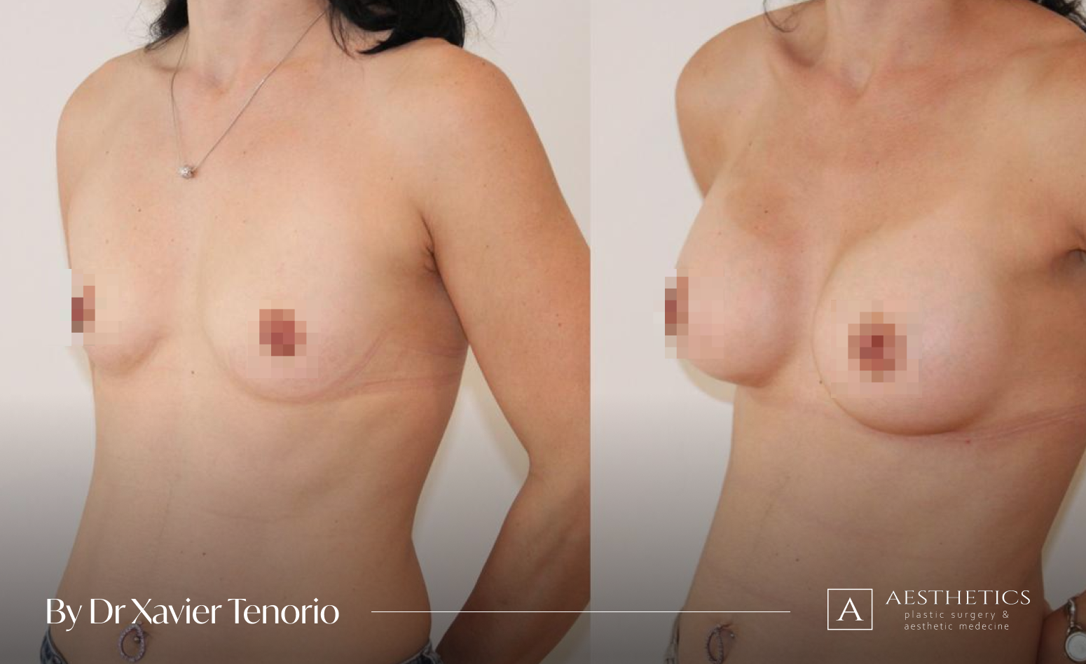 Belle augmentation mammaire