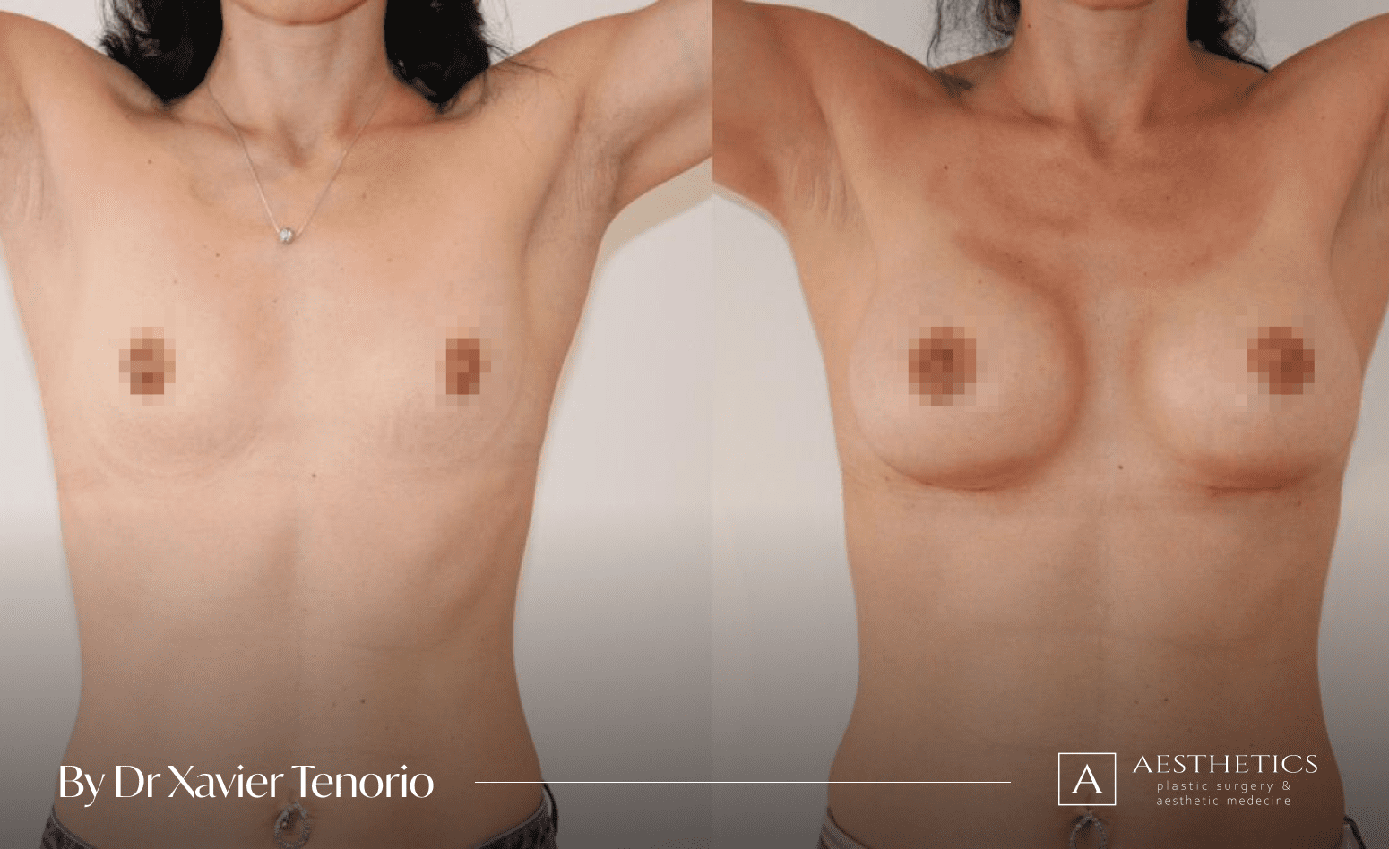 Geneve augmentation mammaire