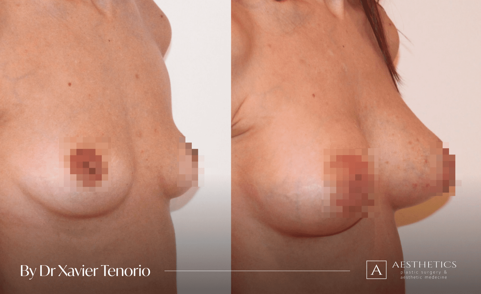 Lipofilling mammaire Geneve