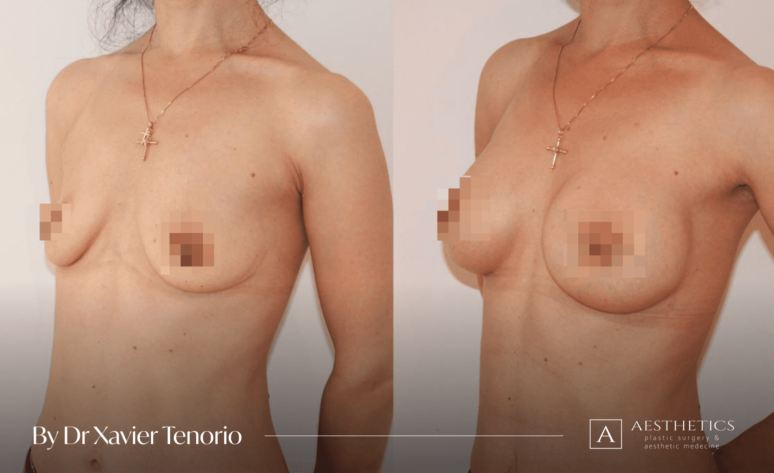 Magnifique augmentation mammaire