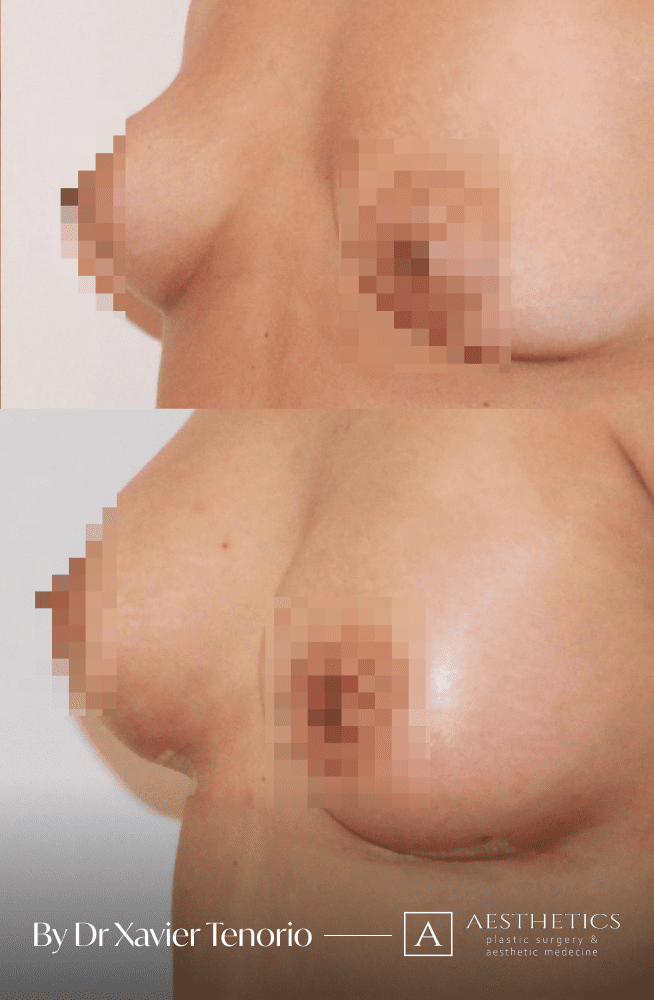 Volume augmentation mammaire Geneve