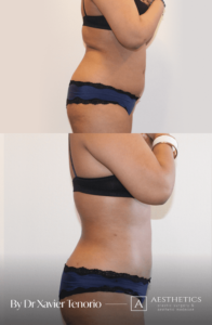 Liposuccion Genève Liposuccion Genève