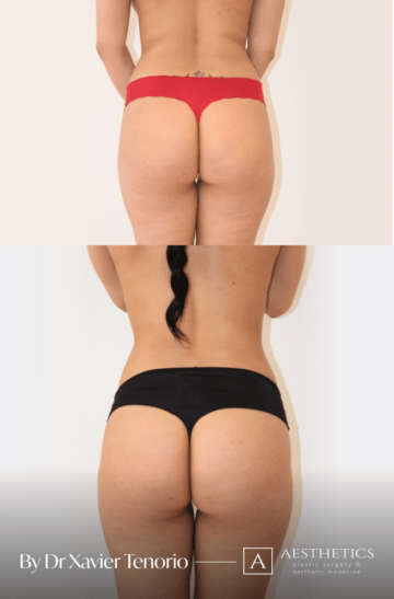 Liposuccion Genève CH Liposuccion fesses Genève