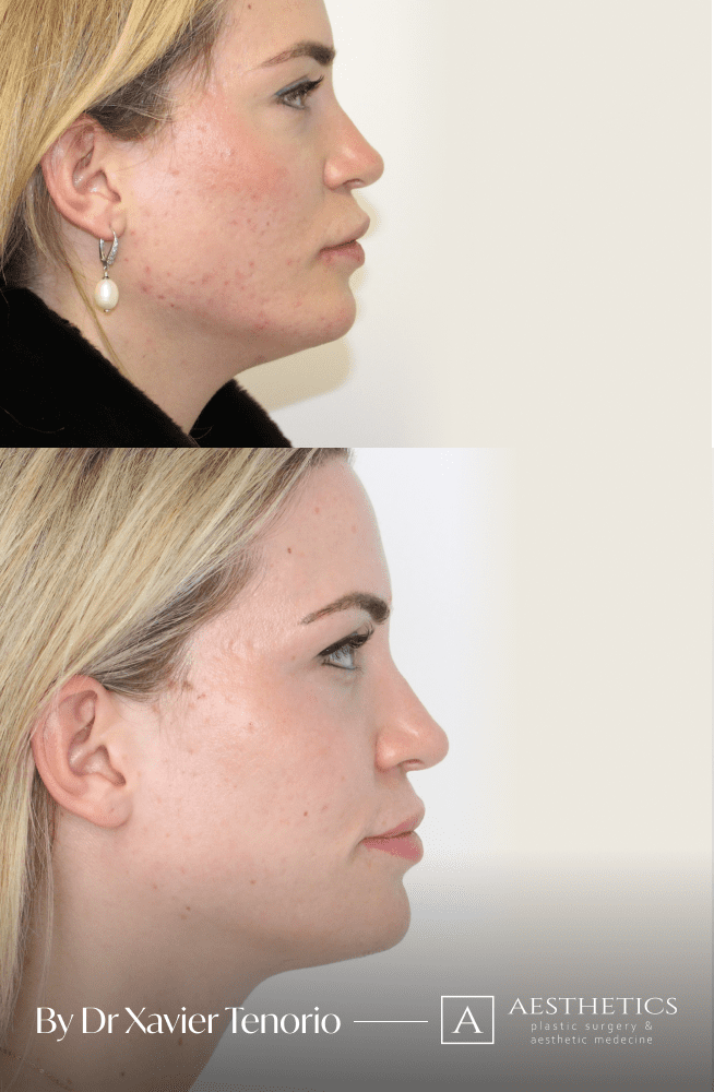 Liposuccion Geneve Suisse Liposuccion Menton Genève