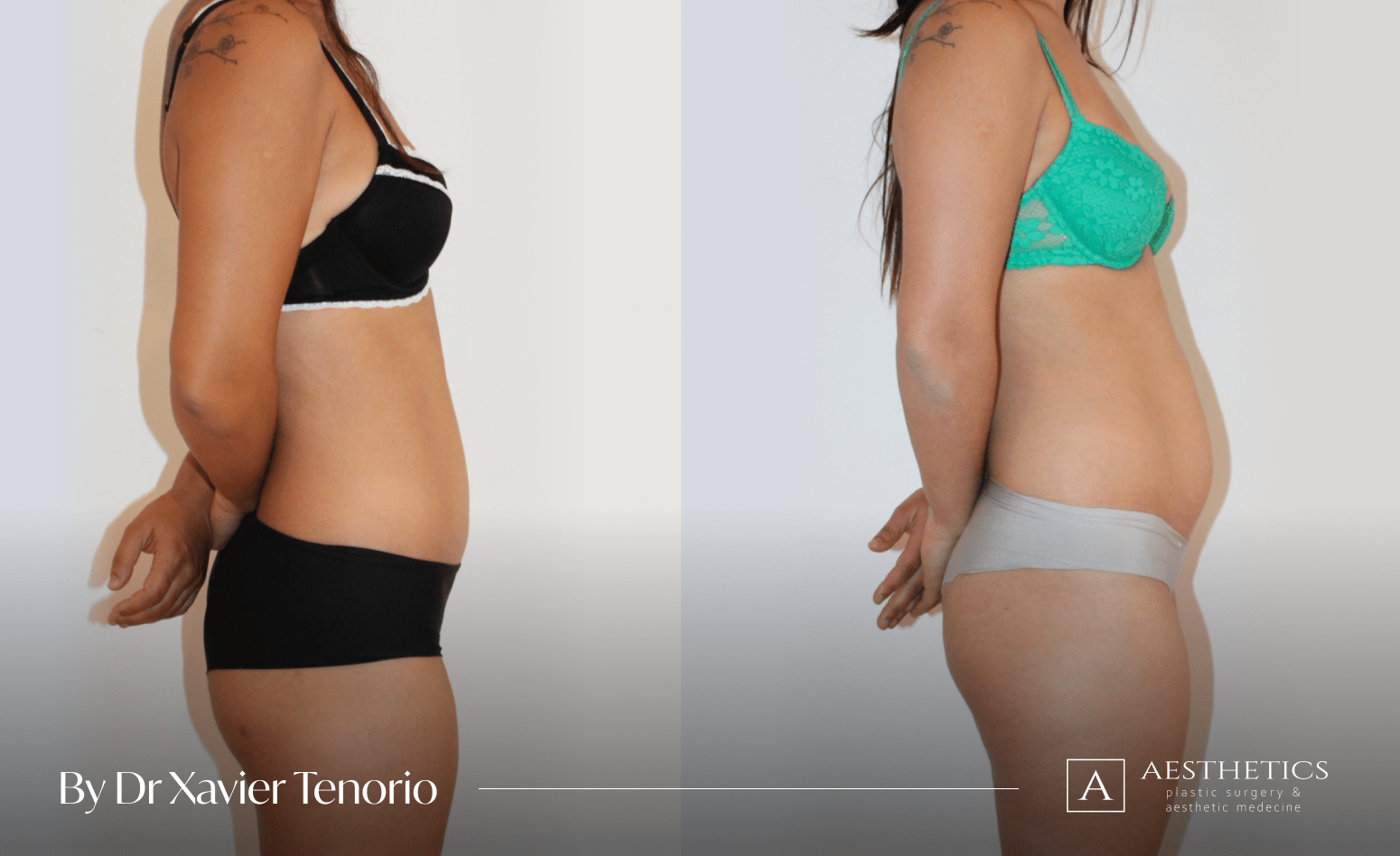 Liposuccion Genève Suisse Liposuccion ventre Suisse