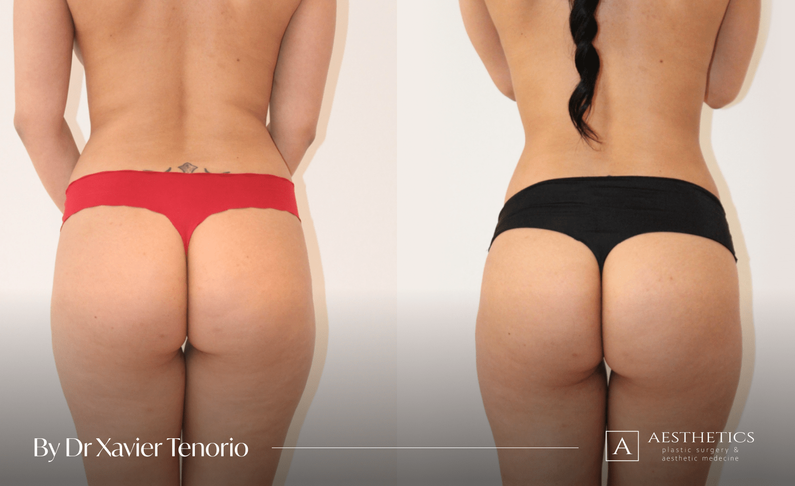 Liposuccion avant après Suisse Liposuccion pour les fesses
