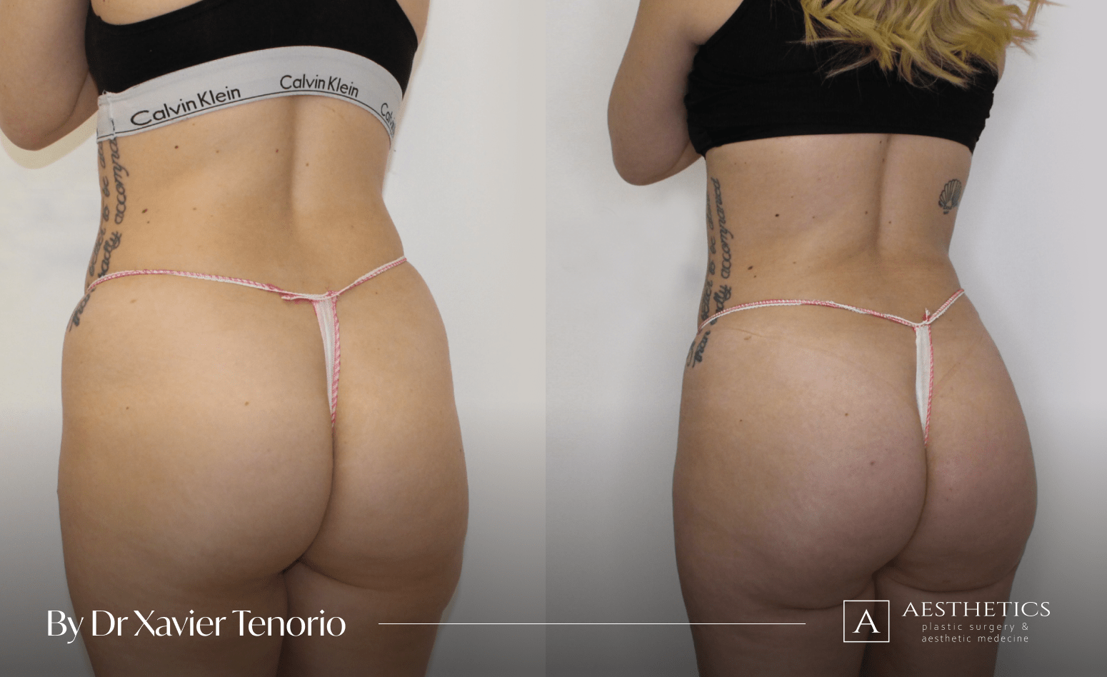 Liposuccion fesses Genève Liposuccion des fesses