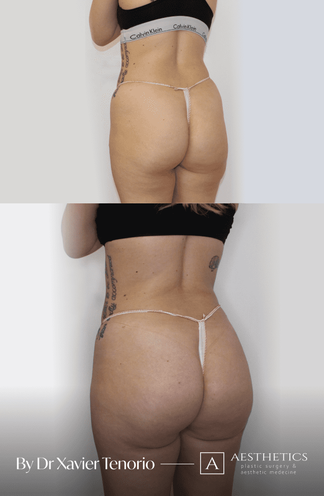 Liposuccion fesses Suisse Genève Liposuccion des fesses Suisse