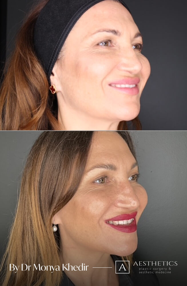 514